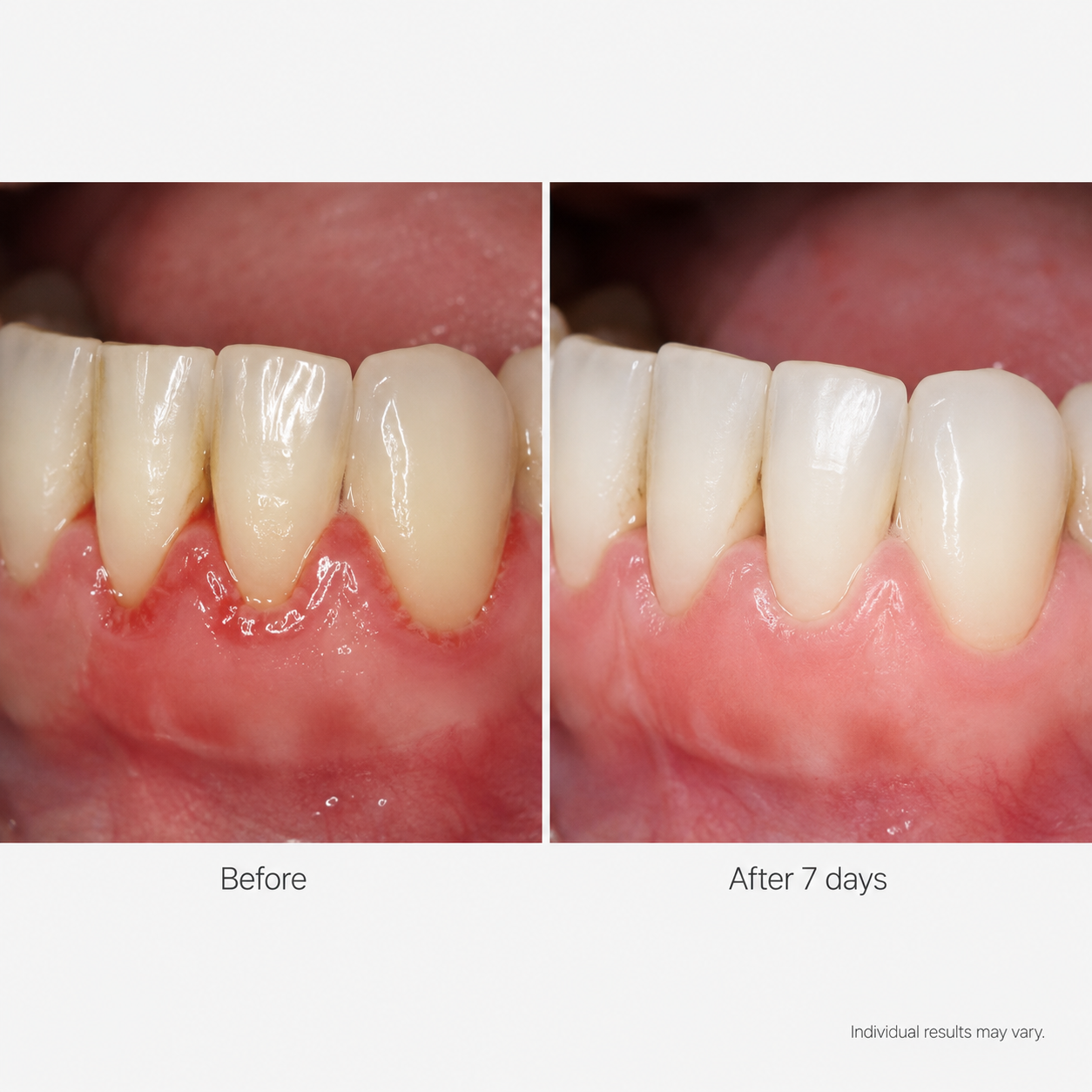 TideSmile Pro Water Flosser