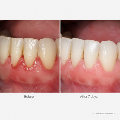 TideSmile Pro Water Flosser